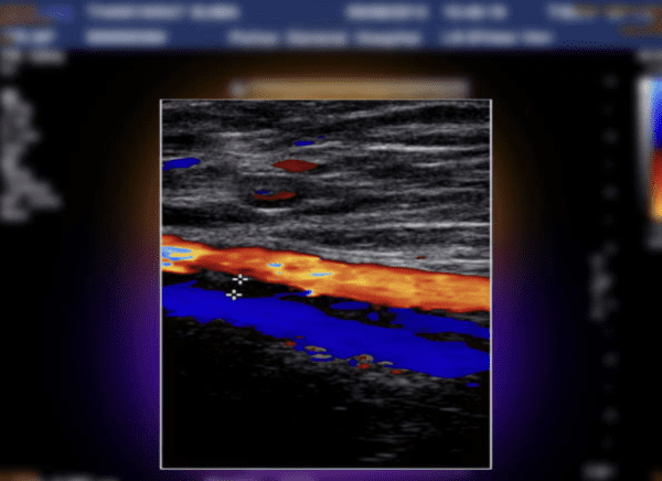 Color Doppler Diagnosis