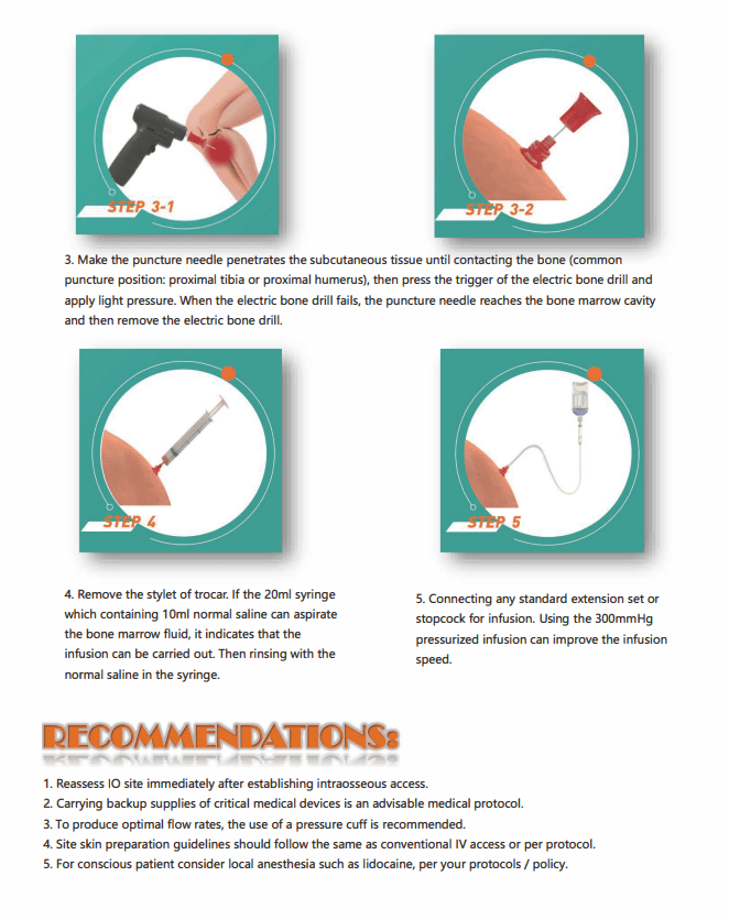 Система внутрикостной инфузии2