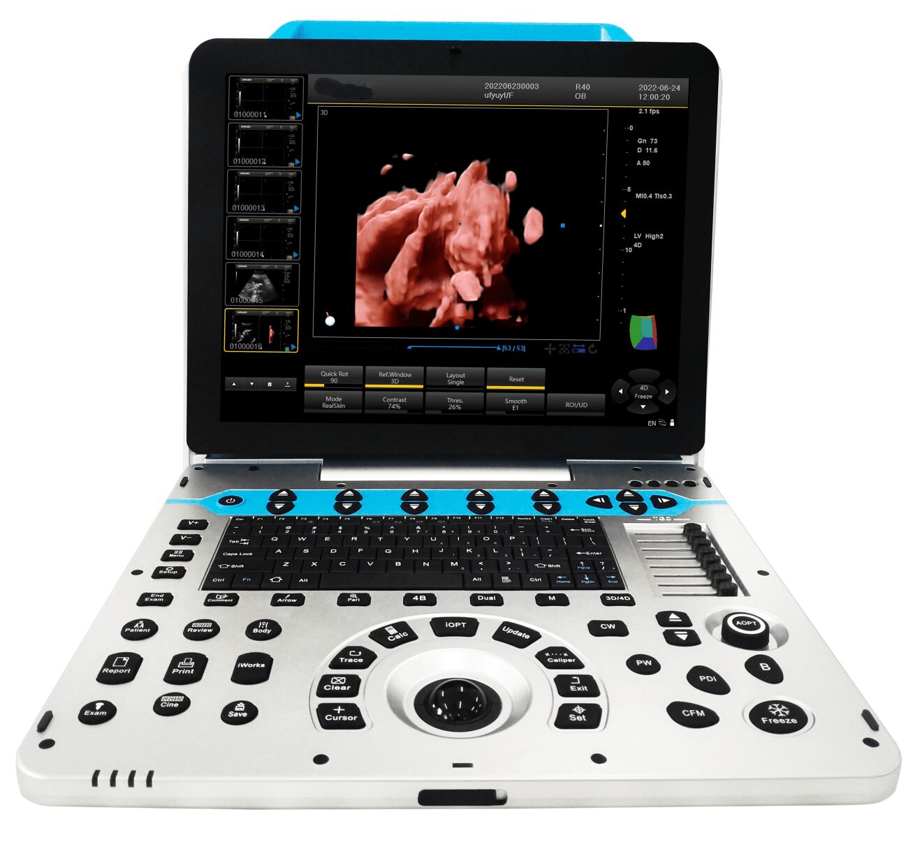 الموجات فوق الصوتية دوبلر الملونة في الحمل 1