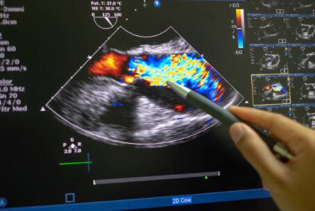 doppler test for heart