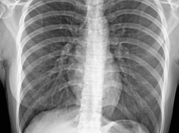 Normal X Ray Scan Normal Chest X-Ray