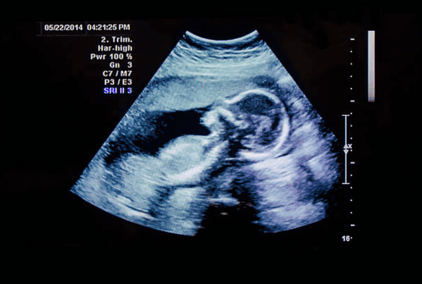 Ultrasound Scanner Machine 3