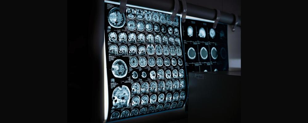 Floor Mounted DR X-ray System vs Portable X-ray with Trolley